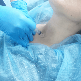 Биопсия щитовидной железы и образований